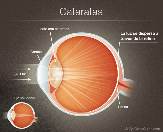 cataracts